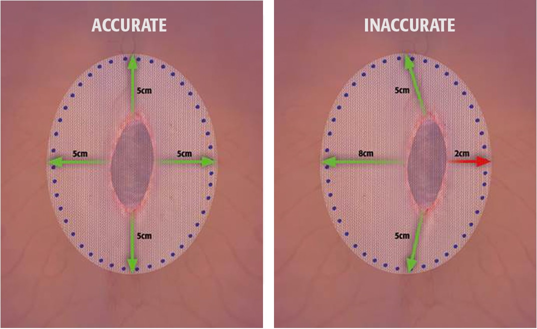 Accurate mesh overlap and centering can improve results